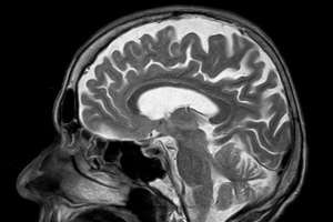 Image of a human skull and brain as seen by an MRI scanner